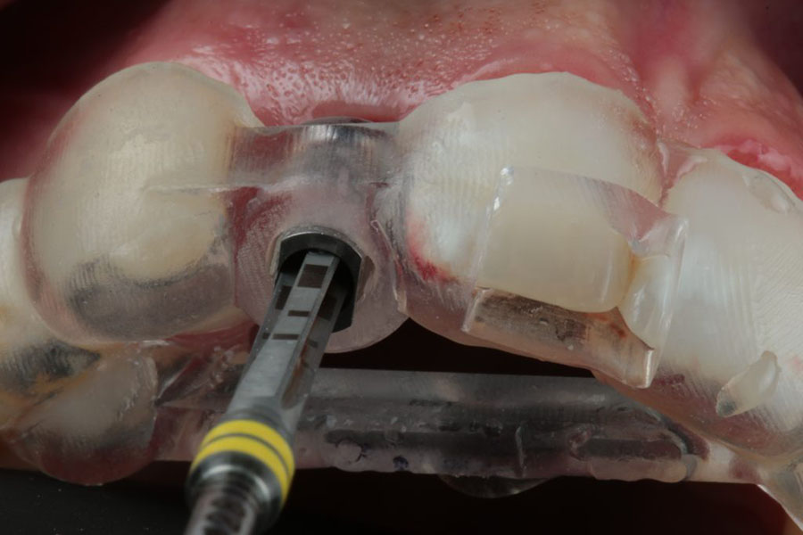 Surgical Guide - Seated in Mouth