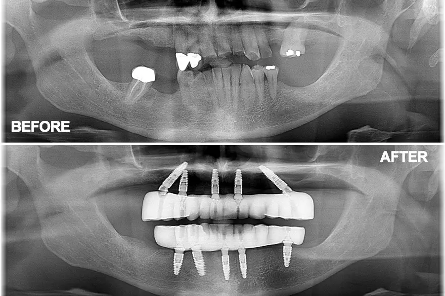 all on 4 implant diagram xray, Memphis, tn