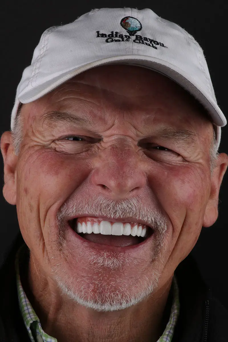 all on 4 patient smile before after, memphis, tn, dr. adatrow