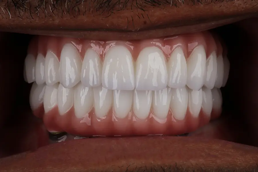 all on 4 zirconia bridge final result intraoral memphis