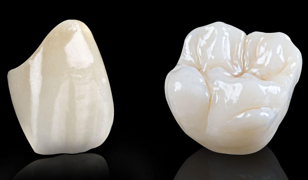 custom porcelain zirconia dental implant crown studio lifelike natural finish memphis