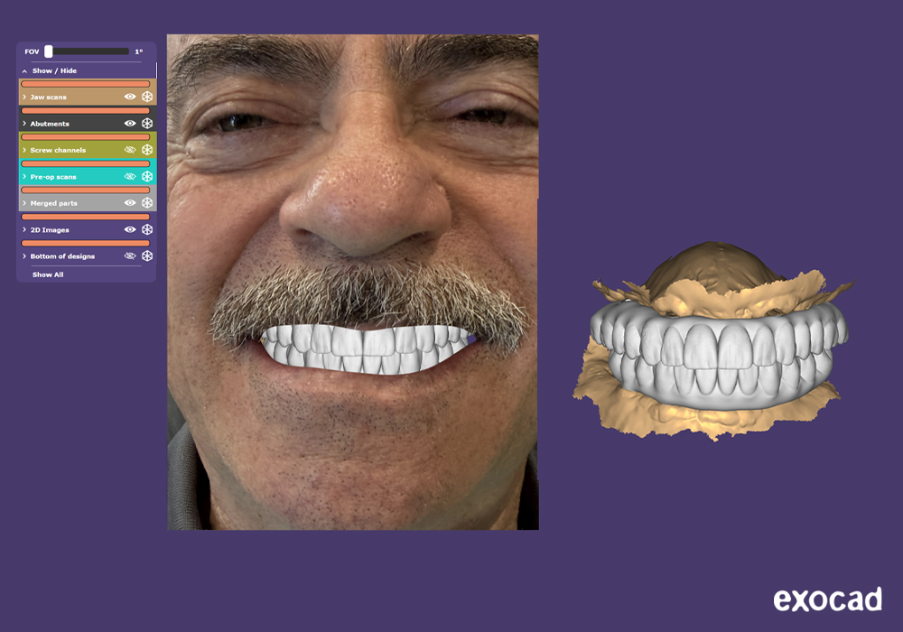 dental implant 3d virtual treatment planning software jaw implant positions Memphis, TN