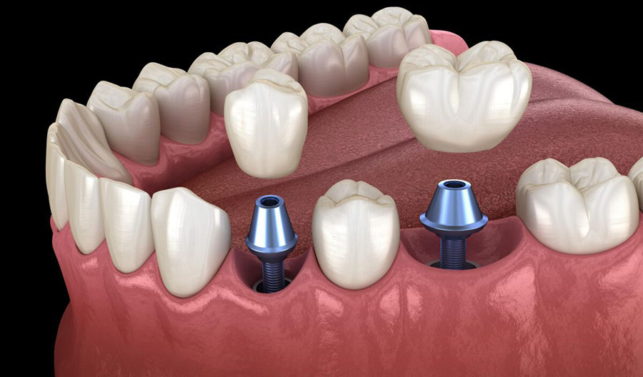 dental implant abutment connector piece implant to crown connection studio photo