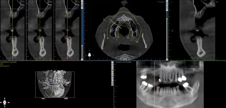 dental implant bone graft cbct cross section jaw bone deficiency Memphis, TN