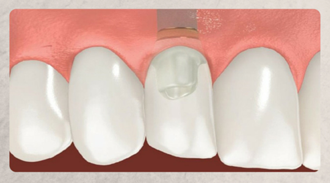 dental implant crown color match translucency macro detail intraoral memphis tn