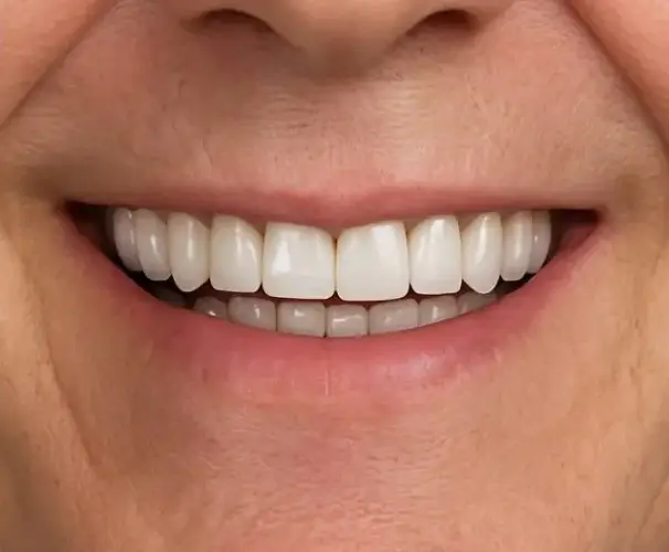 implant-supported bridge after fixed, natural color match, Memphis, TN