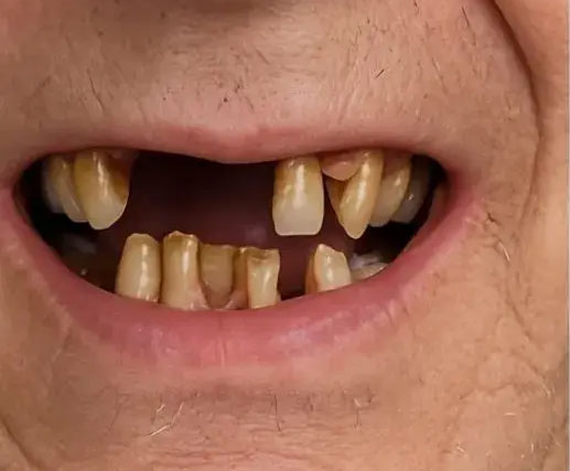implant-supported bridge before adjacent missing teeth gap, intraoral, Memphis, TN.