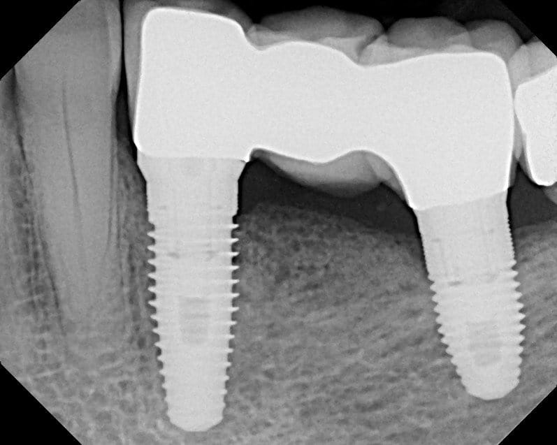 implant supported bridge xray panoramic two implants no grinding adjacent teeth