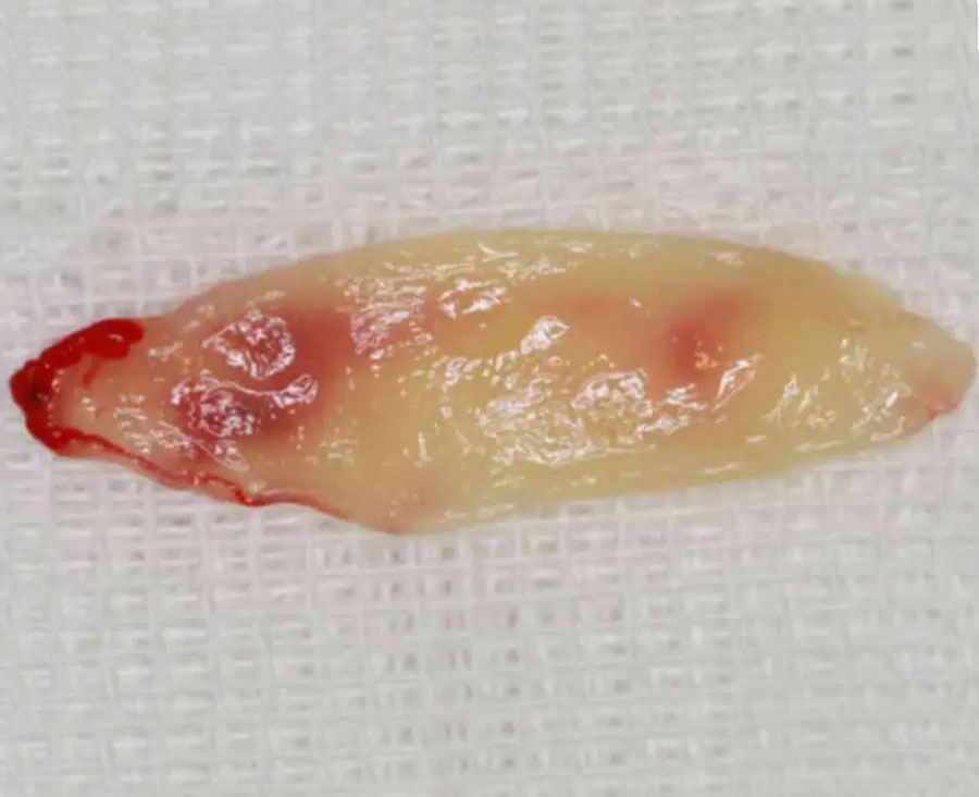 prf platelet rich fibrin membrane chairside preparation dental bone graft memphis