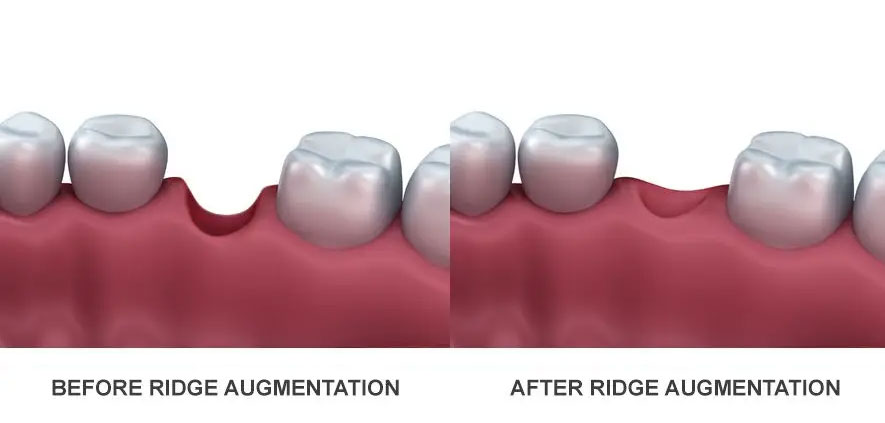 ridge augmentation bone graft after healed restored jaw ridge implant ready