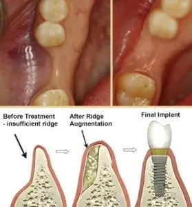 ridge augmentation bone graft before narrow resorbed alveolar ridge, Memphis