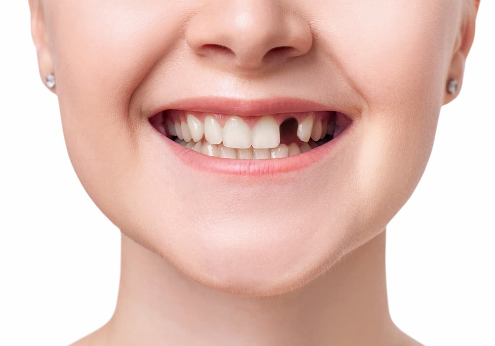 single tooth implant before missing upper front tooth intraoral homepage memphis
