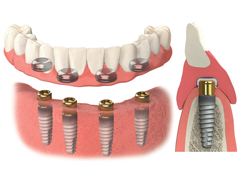 snap on denture locator attachment mechanism implant abutment macro close up