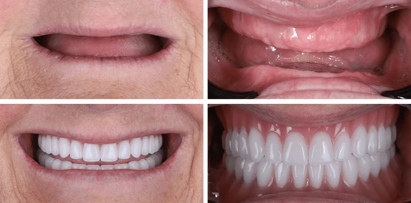 snap on implant denture before after portrait facial support smile transformation memphis.