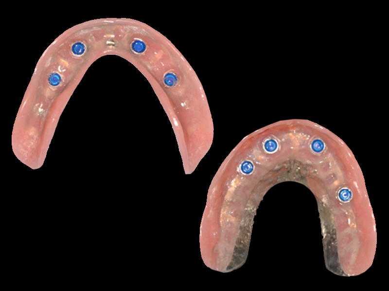 snap on overdenture underside locator inserts housing denture base studio photo.