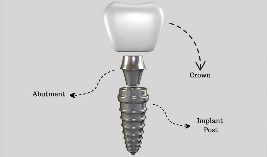 titanium dental implant post close up threading surface studio dr adatrow memphis