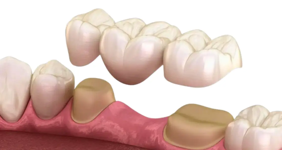 Traditional bridge vs. implant bridge ground tooth comparison diagram, Memphis.